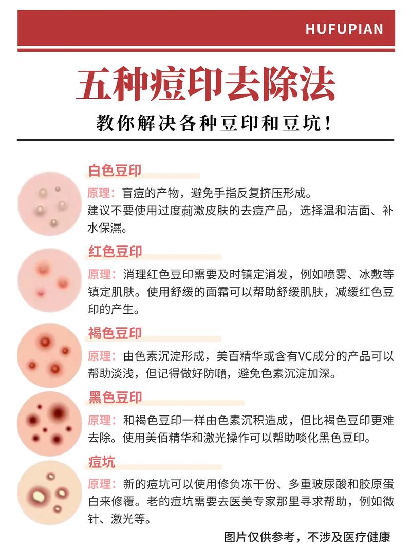 全面指南：有效消除痘印的方法和建议