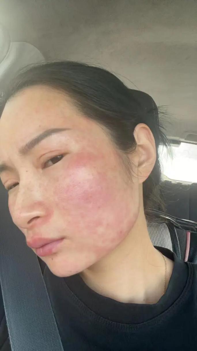 详细阅读:饮酒与皮肤问题 饮酒与皮肤问题