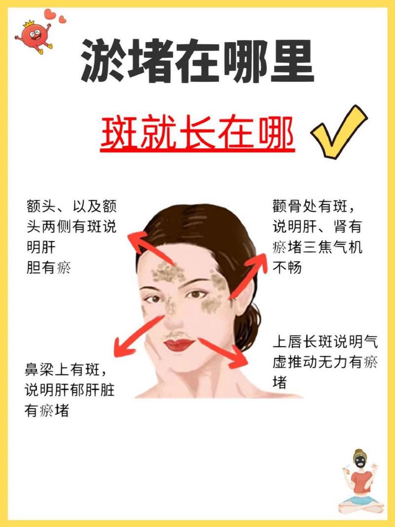雀斑成因与淡化