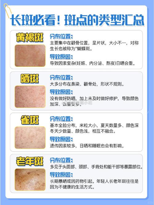全面解析色斑种类及其有效去除方法