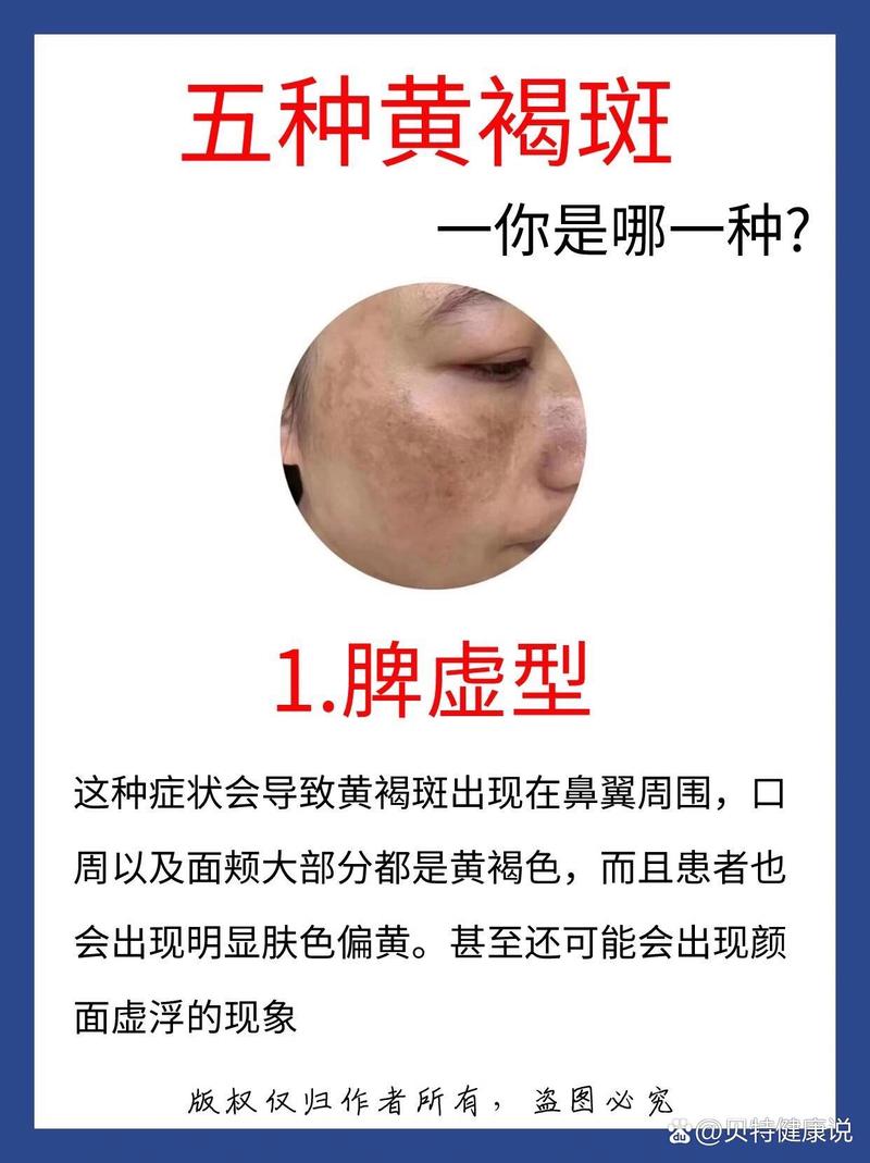 黄褐斑形成与治疗全解析