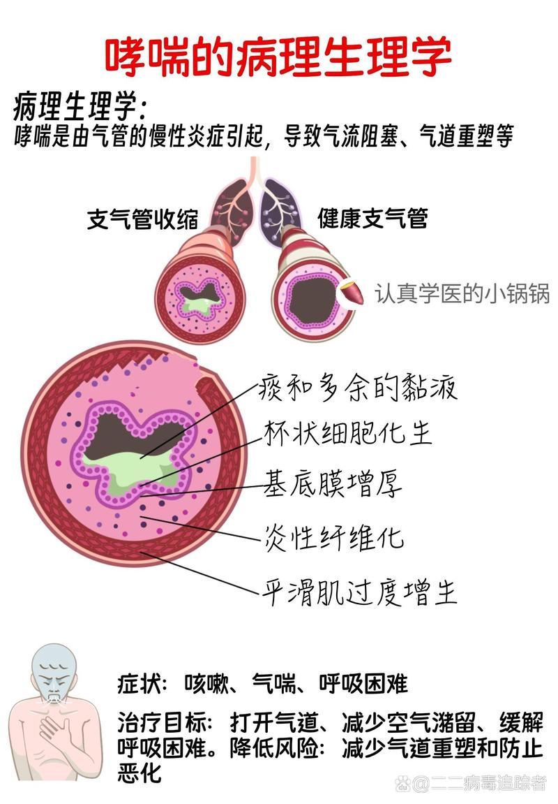 哮喘：了解、应对与管理
