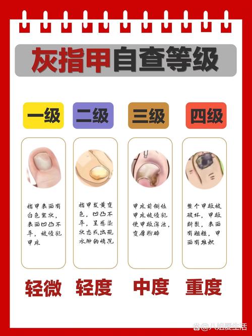 灰指甲的全面治疗方法解析