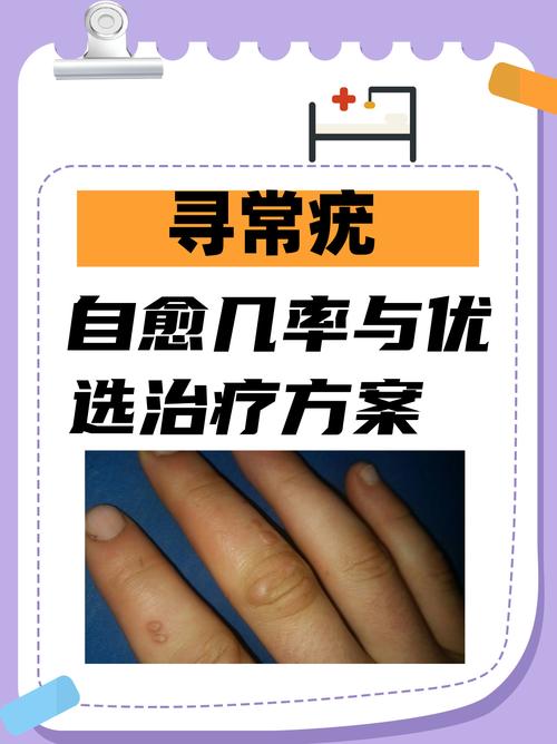 寻常疣的全面治疗与去除策略