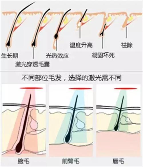激光脱毛与光子脱毛：原理、效果及适用性的全面对比
