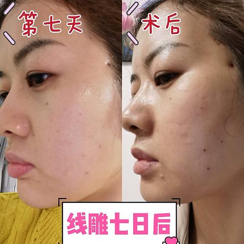 线雕美容介绍与恢复过程