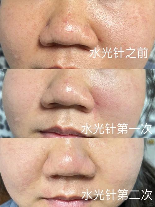 水光针与水光枪：美容界的“双子星”，究竟有何差异？