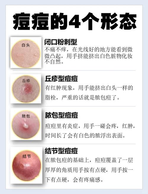 背部痘痘消除方法：重拾光洁肌肤的秘诀