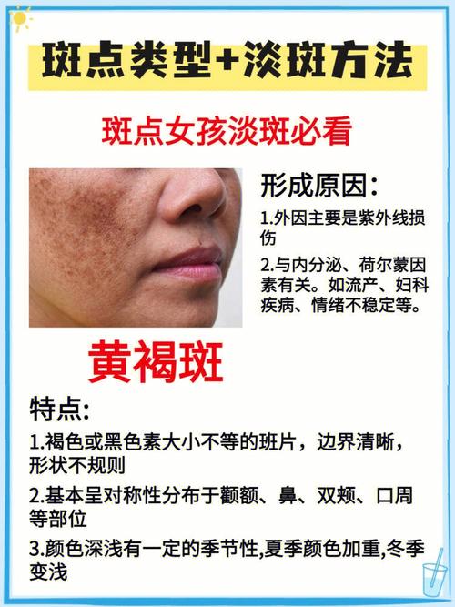 详细阅读:雀斑的成因与淡化:探索皮肤上的微妙印记 雀斑的成因与淡化:探索皮肤上的微妙印记