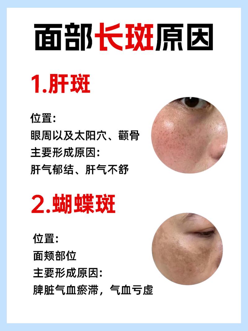 详细阅读:黄褐斑形成与治疗 黄褐斑形成与治疗