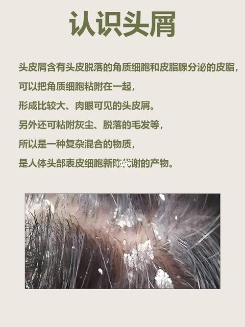 头皮屑产生原因与去除全解析