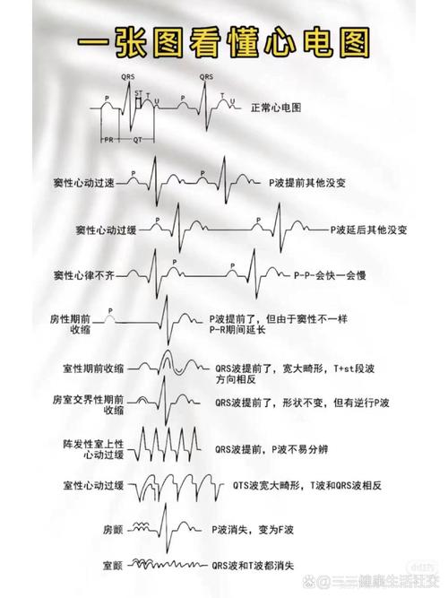 心律失常：心脏的不和谐乐章