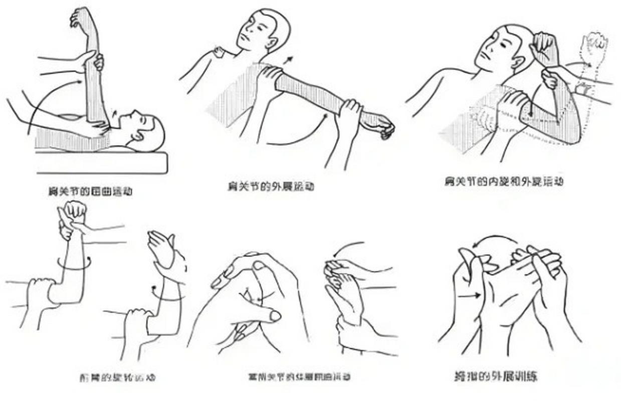 偏瘫：了解、康复与预防的全方位解读