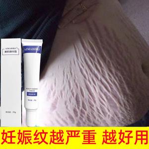 妊娠纹修复霜：重塑平滑肌肤的希望之光