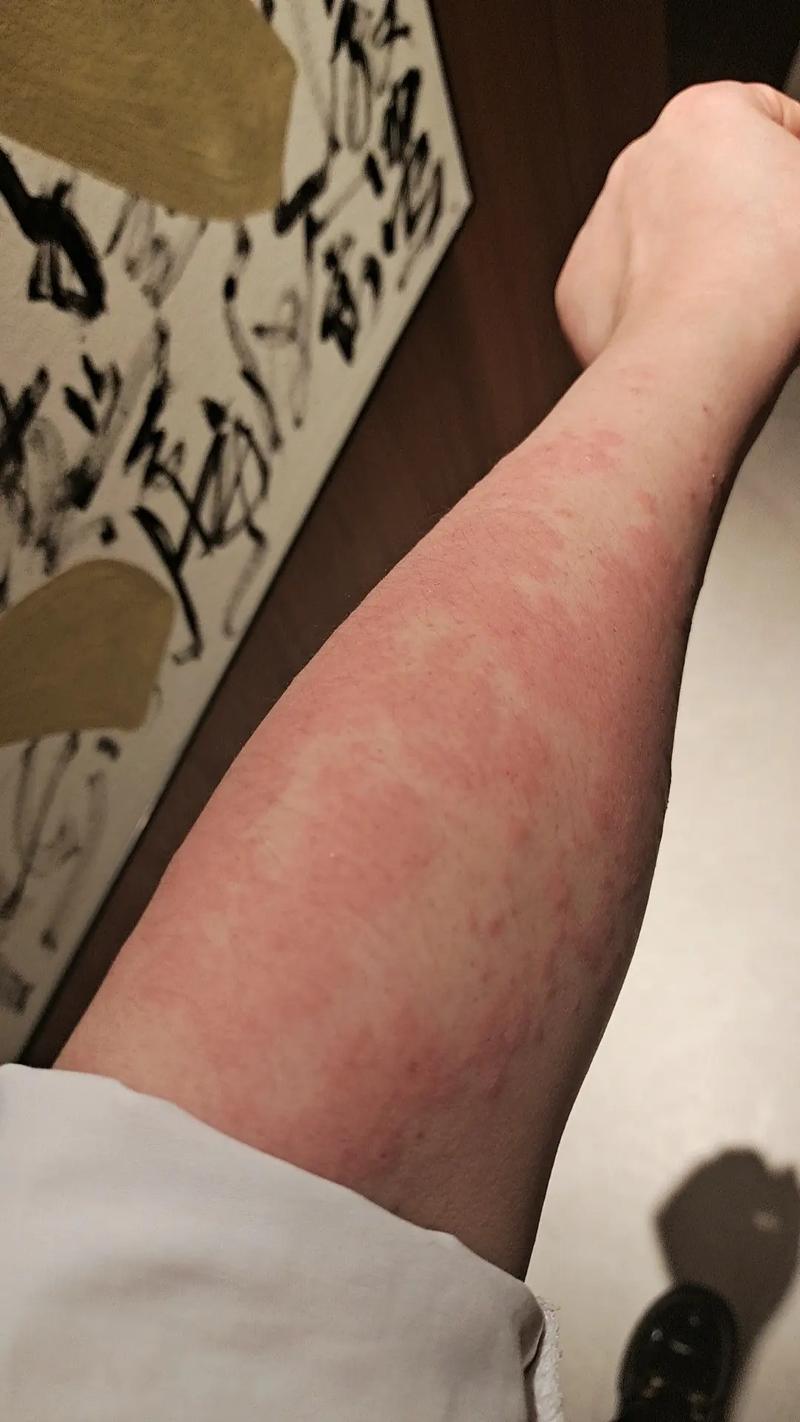 过敏：当身体对世界“反应过度”