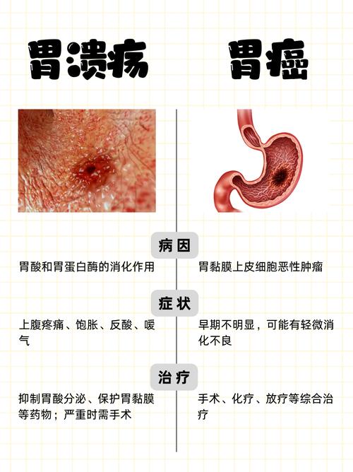 胃溃疡：认识与防治