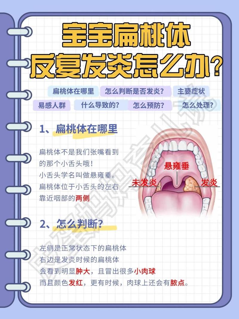 全面了解扁桃体炎：症状、原因、治疗与预防全攻略
