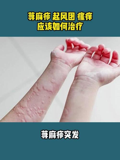 荨麻疹的有效治疗之道：多维度策略与全面解析