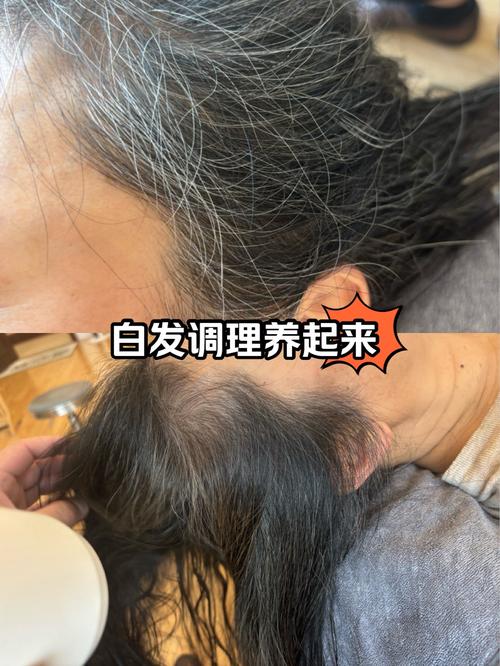 白发的治疗与调理全攻略：从根源入手，恢复健康秀发