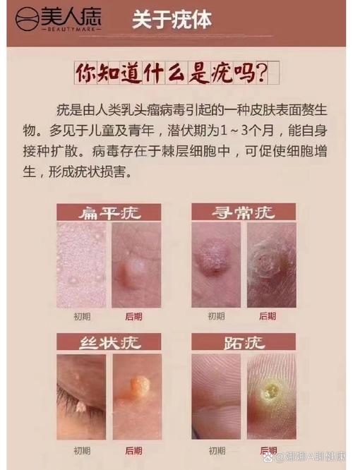 寻常疣的治疗与去除：全面解析与有效方法
