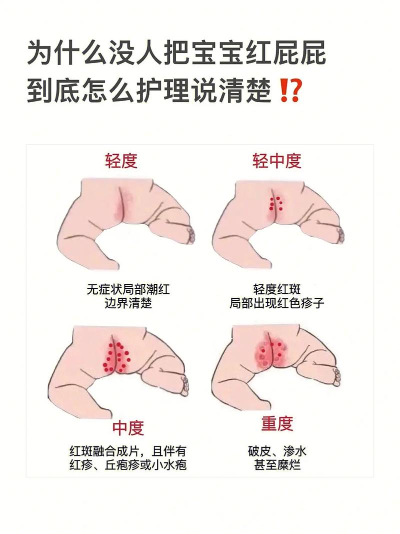 宝宝红屁屁全攻略：守护娇嫩屁屁的实用指南