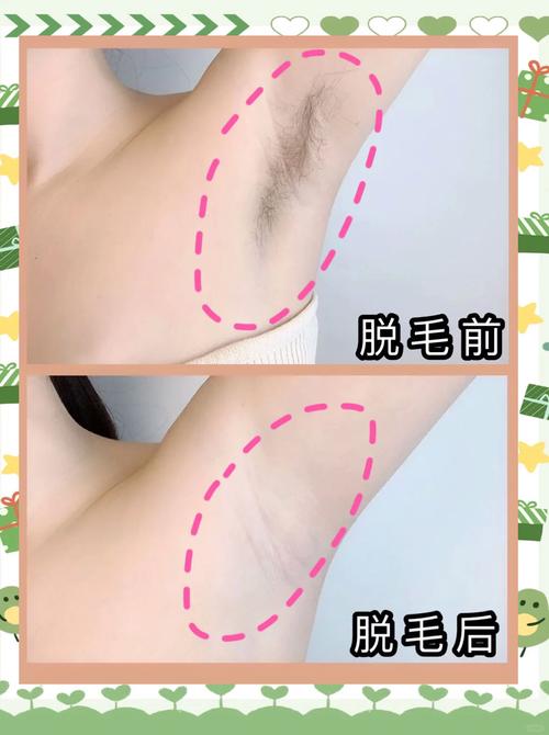 身体脱毛全攻略：告别繁琐，拥抱丝滑肌肤