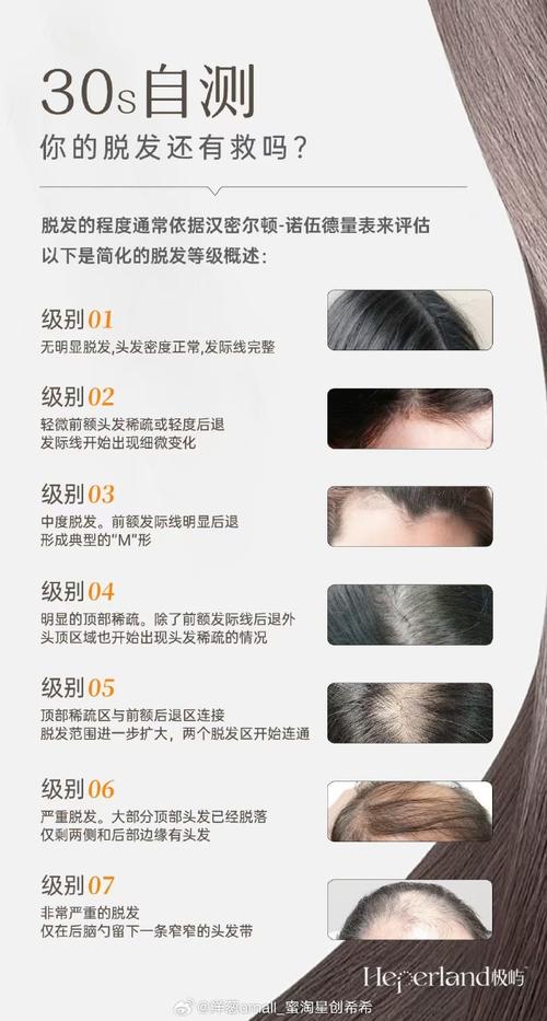 详细阅读:头发护理与脂溢性脱发发膜的深度解析 头发护理与脂溢性脱发发膜的深度解析