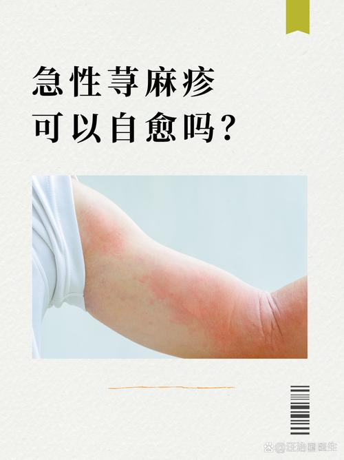 急性病：不容忽视的健康“急”风
