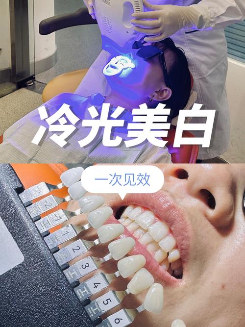 冷光美白牙齿：原理、过程全解析