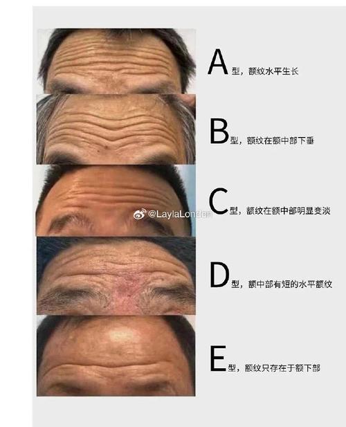 远离抬头纹，重拾平滑额头