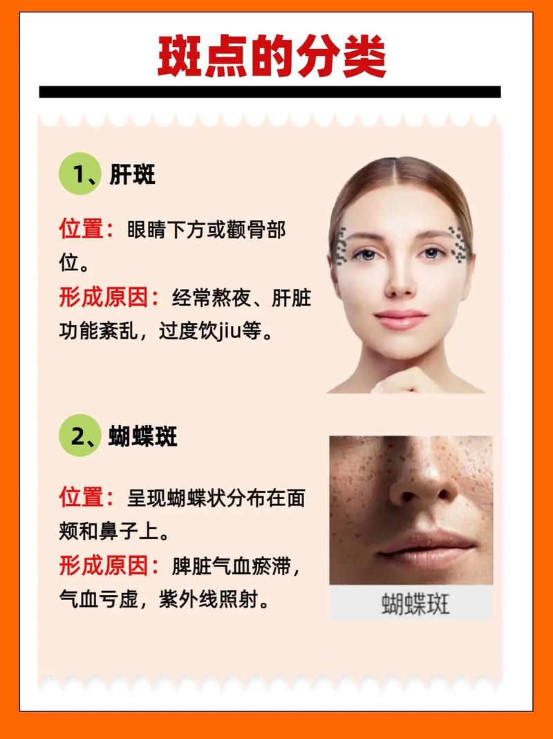 雀斑的成因与淡化：探索美丽肌肤的秘密