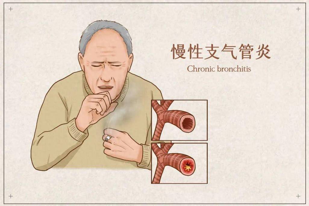 支气管炎治疗：多维度解析，助患者重获呼吸自由