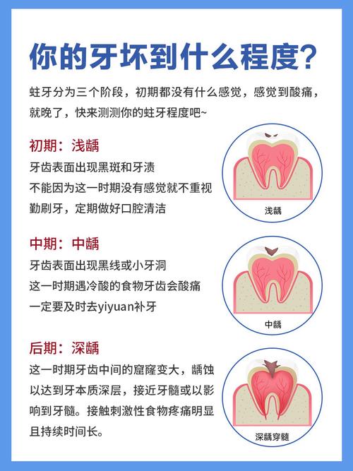 龋齿的治疗与预防全攻略