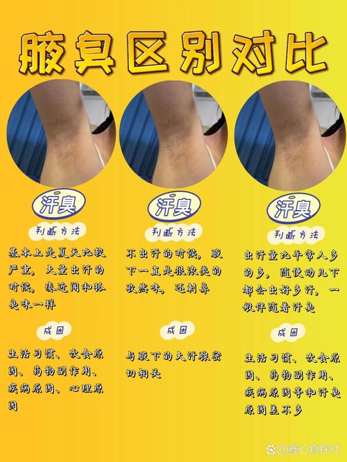 狐臭的治疗与改善：全面指南