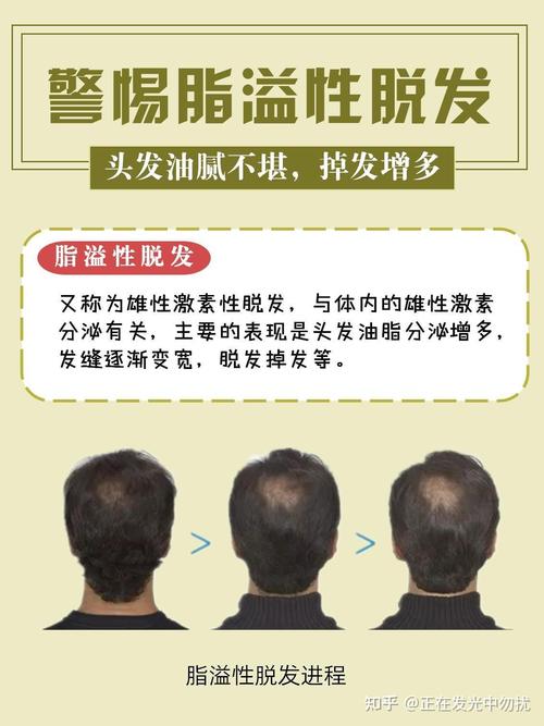 脂溢性脱发治疗方法全解析