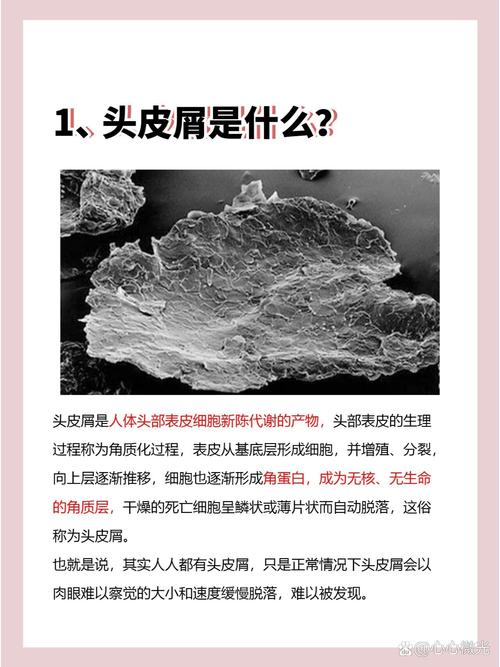 头皮屑产生原因与去除：全面解析头皮健康问题