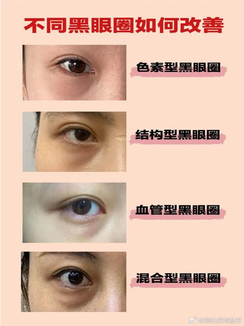 眼部黑眼圈减轻：多维度探寻改善之道
