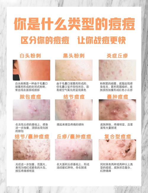 痘痘肌护理全攻略：科学应对，重拾肌肤清透之美