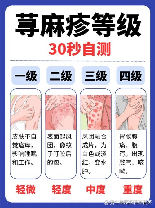 荨麻疹：从症状到防治的全方位解析