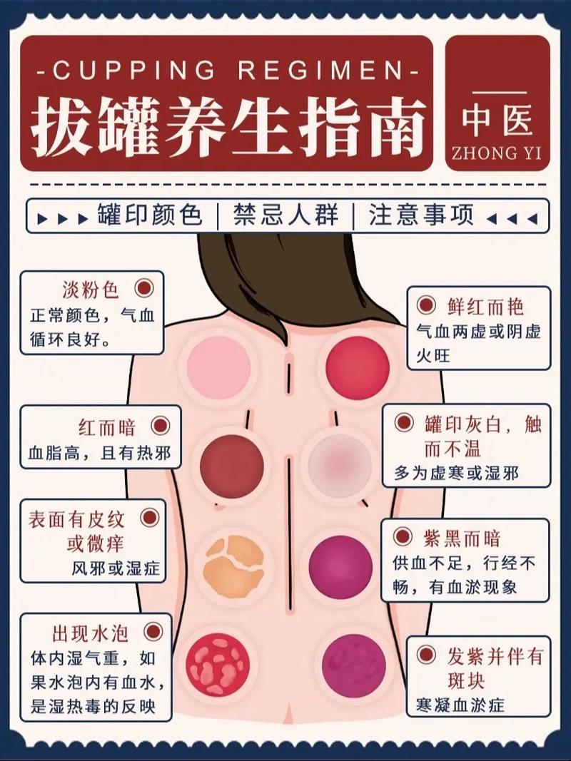 身体拔罐：传统疗法的奥秘、功效与注意事项