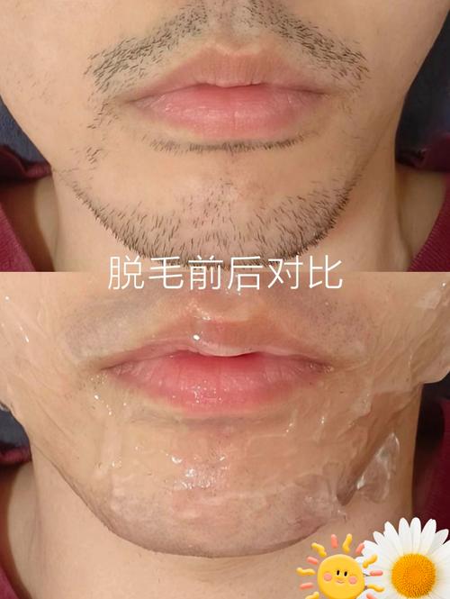 身体脱毛：告别“毛手毛脚”，拥抱光滑肌肤