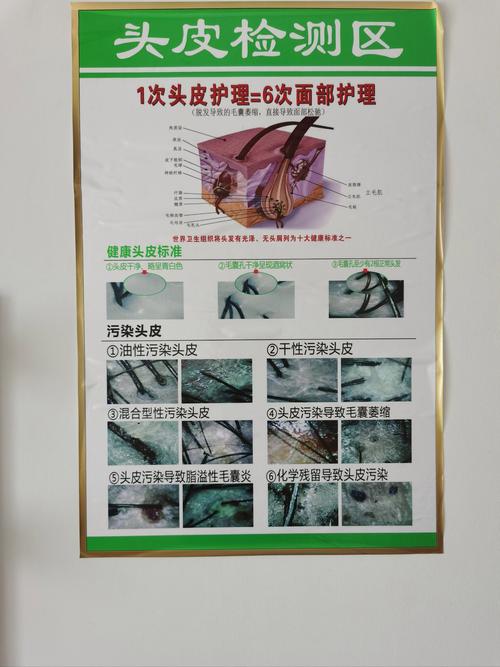 守护头皮健康：头发与头皮炎症的全方位护理指南