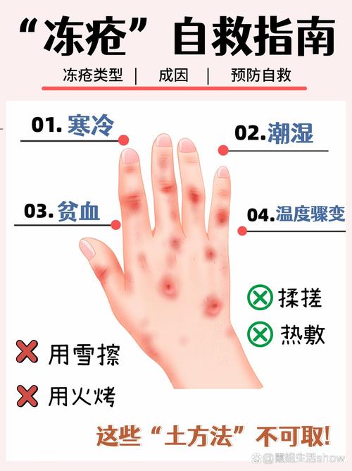 冻伤的治疗与预防全攻略
