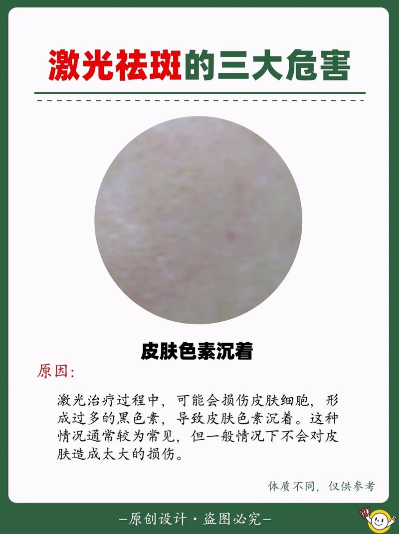 揭秘激光祛斑：科技与美丽的完美融合之旅