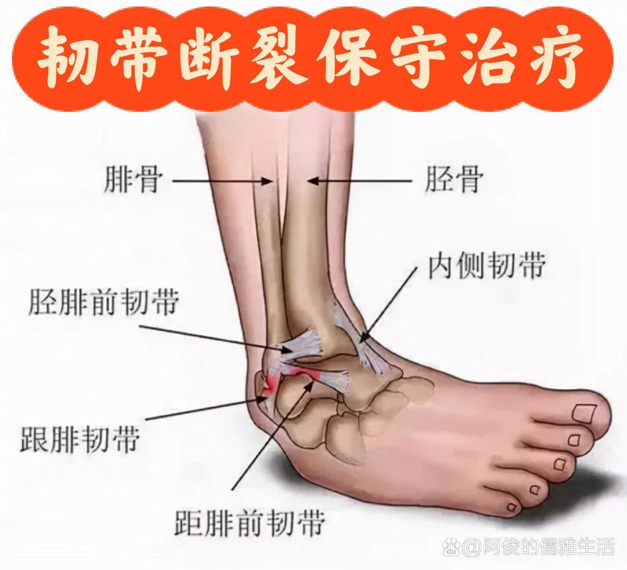 韧带拉伤的治疗：全面解析