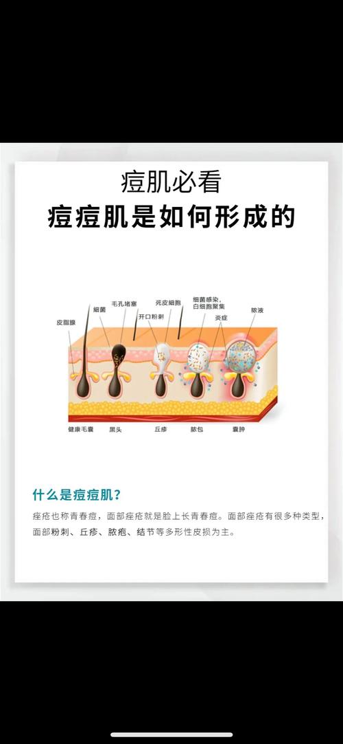 详细阅读:痘痘形成原因全解析:多因素交织的皮肤困扰 痘痘形成原因全解析:多因素交织的皮肤困扰