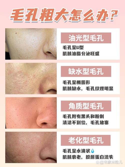 毛孔粗大原因剖析：探寻肌肤背后的“秘密”
