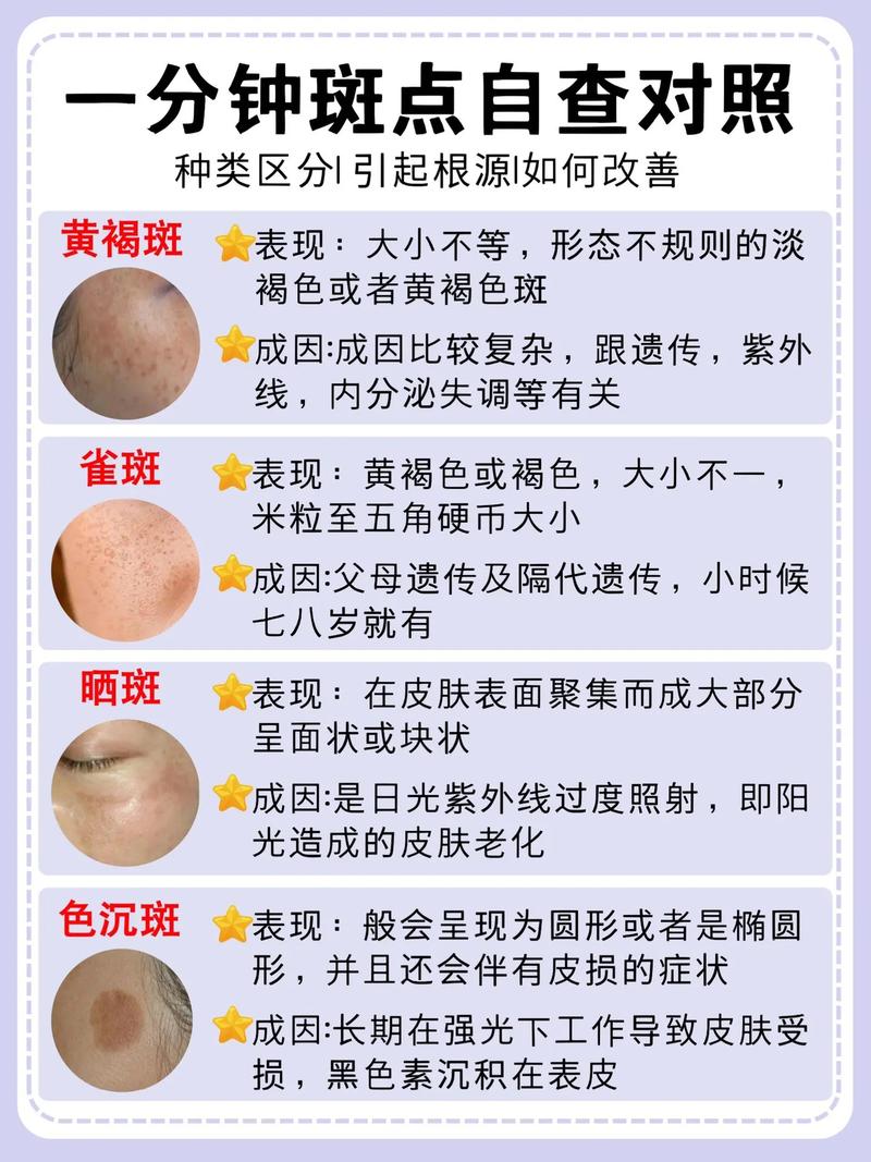 详细阅读:色斑的种类与有效去除方法全解析 色斑的种类与有效去除方法全解析