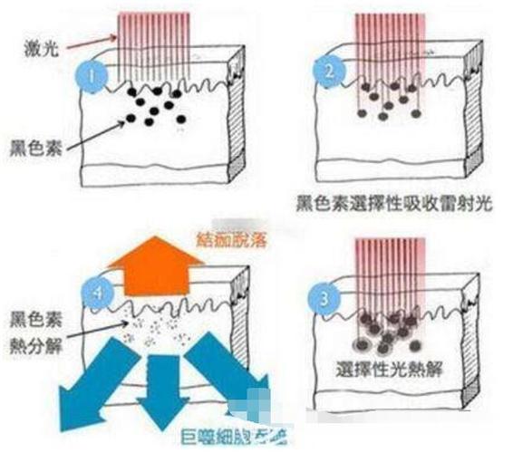 以下是关于激光祛斑技术与原理的详细介绍：