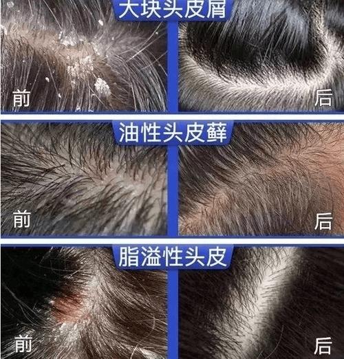 头皮屑产生原因与去除